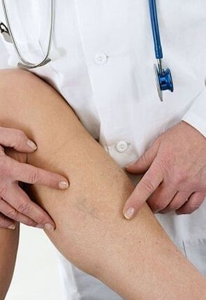 Az alsó végtagok varikózisai