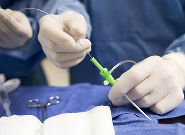 Rádiófrekvenciás abláció